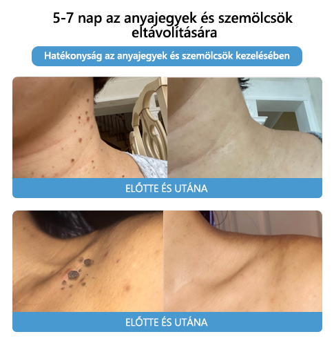 【Hivatalos márkabolt】 Lenaro™ méhméreg vakond- és szemölcskezelő krém (👨‍⚕ESDR AJÁNLJA)