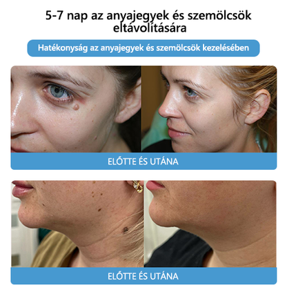 【Hivatalos márkabolt】 Lenaro™ méhméreg vakond- és szemölcskezelő krém (👨‍⚕ESDR AJÁNLJA)